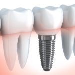Dental implant for tooth replacement showing how an implant attaches to the jaw. Dr. Franck offers a free consultation to discuss Dental Implants for Teeth Replacement. Call our office today to schedule an appointment at 916-415-1913